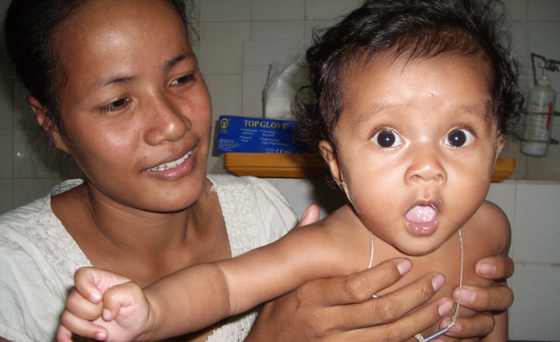 Aktion Lächeln: Ärzte der Welt Teams operieren Kinder, damit sie wieder lächeln können.